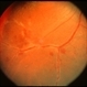 Possible CMV Retinitis with Frosted Branch Angiitis